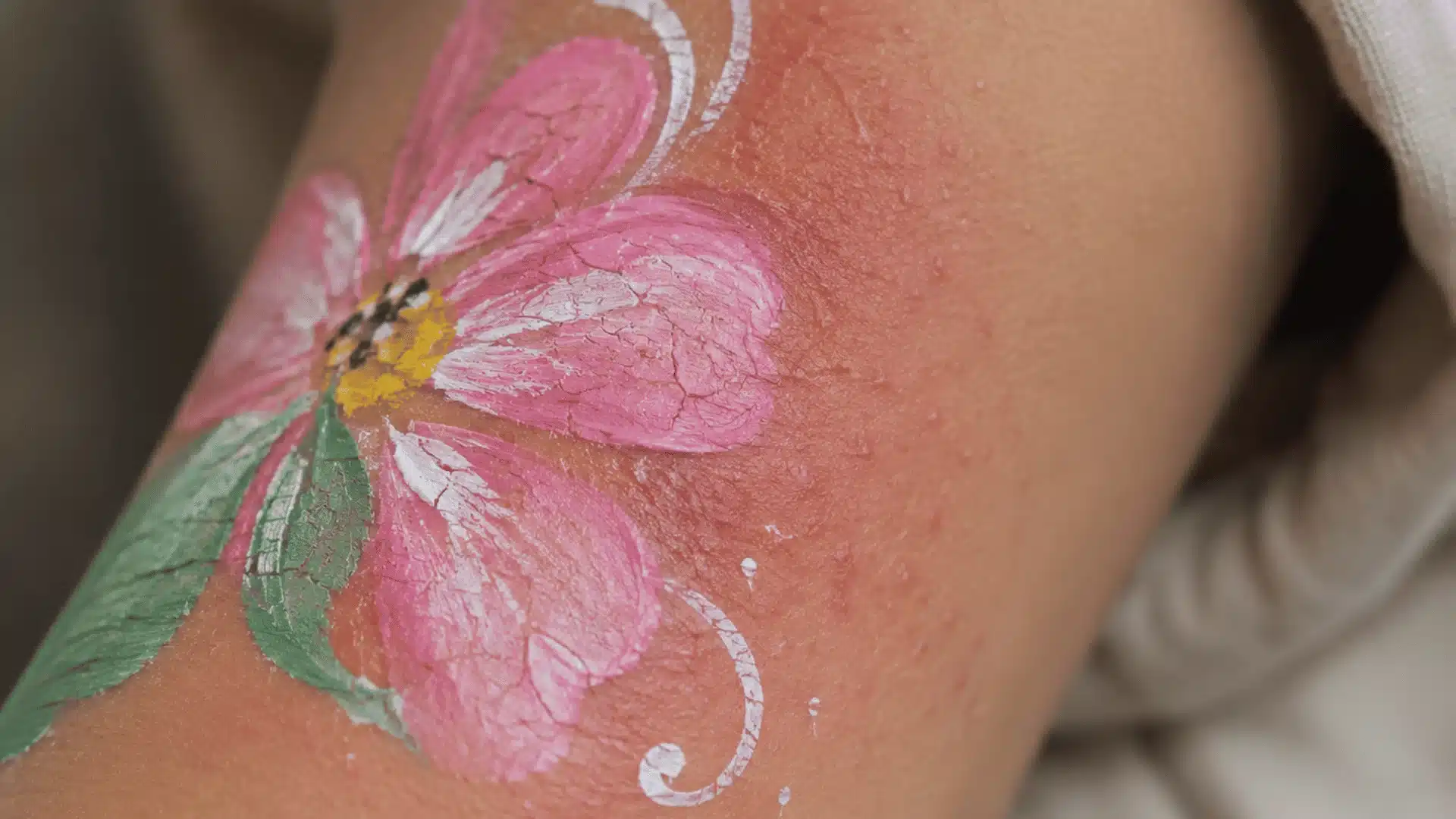 Close-up of irritated skin with cracked painted flower design and visible redness on arm